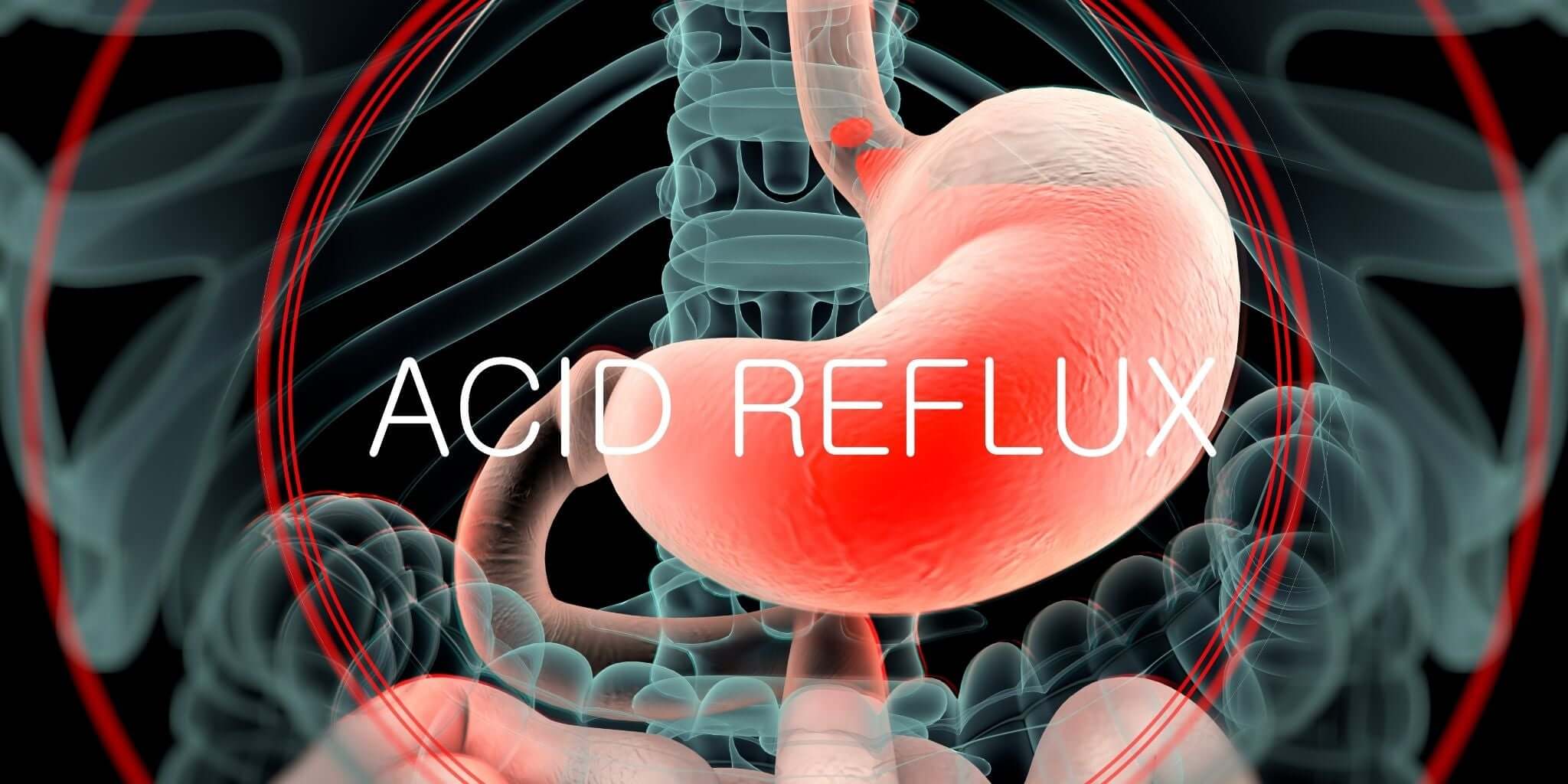 A medical illustration showing a close-up of the stomach with highlighted red areas indicating acid reflux, framed by transparent outlines of the ribcage and digestive system.