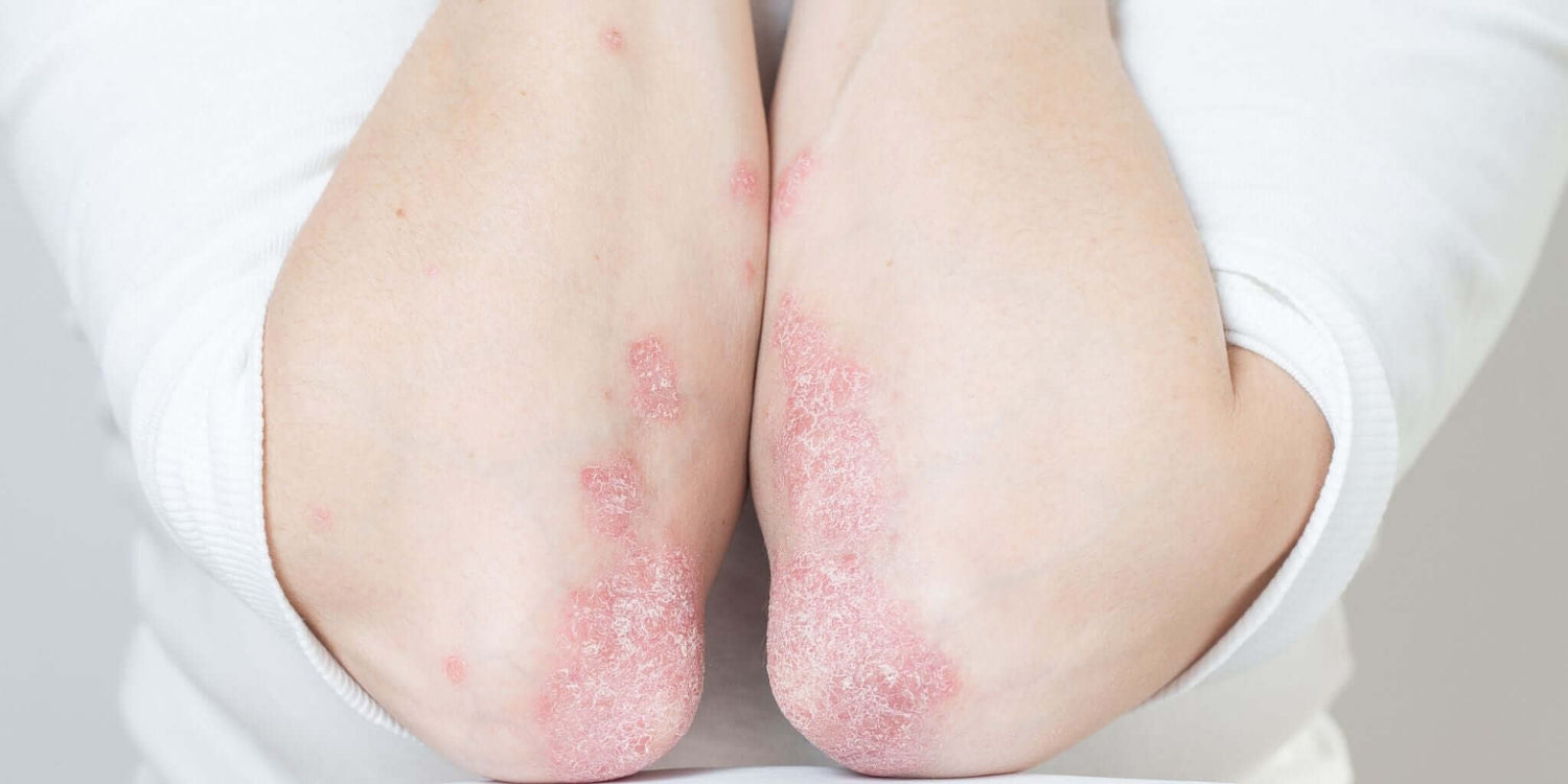 Close-up view of a person's elbows showing red, scaly patches commonly associated with psoriasis, against a neutral background.